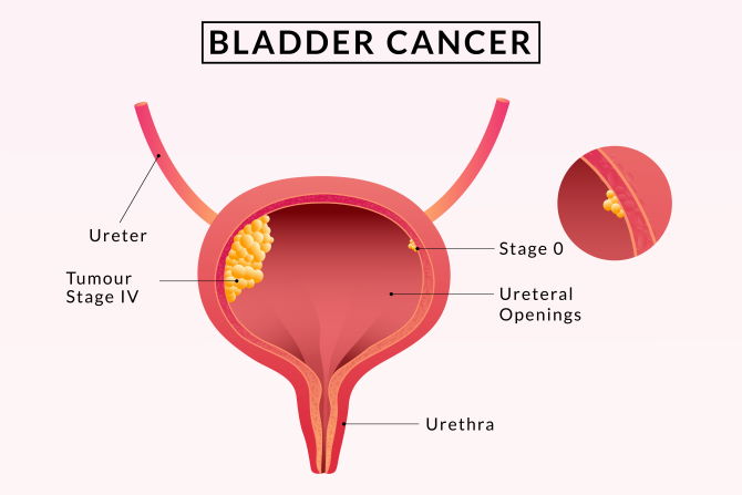 bladder cancer